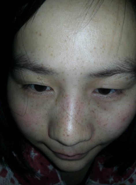 生完宝宝脸上起了妊娠斑 能祛除么?