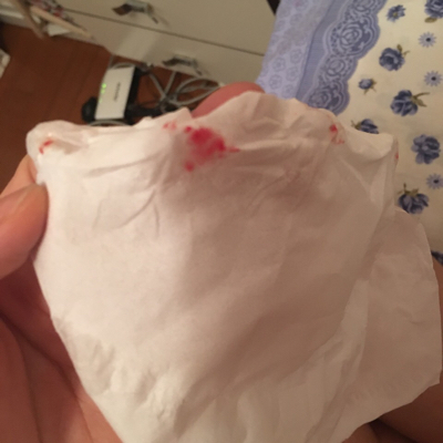 我鼻子天天都出血怎麼回事啊.还不是流的那种.就是一抠就有点.