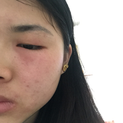 问答 怀孕期 推荐回答                      有时候可能是季节性的