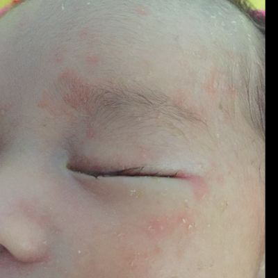 我家宝宝25天了,宝宝脸上的红包是湿疹吗?眉毛中间最多!