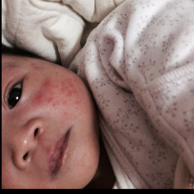 这是红疹还是湿疹