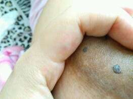 乳晕上长了像黑痣一样的东西,正常吗?