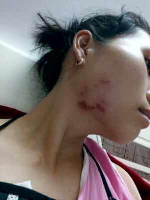 宝妈这挺严重的 还是赶紧找医生看看吧 我前两天脸上有红