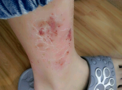 腿天天痒,都挠烂了,越挠越痒,请问这是什麼情况,怎麼治