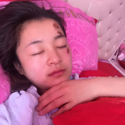 我昨天晕倒了,摔得鼻青脸肿,然后去检查医生给我来了黄体酮,还有