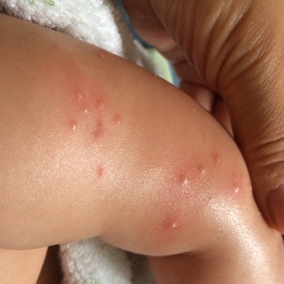 请问有宝妈发现宝宝手臂上这样的痘痘吗?