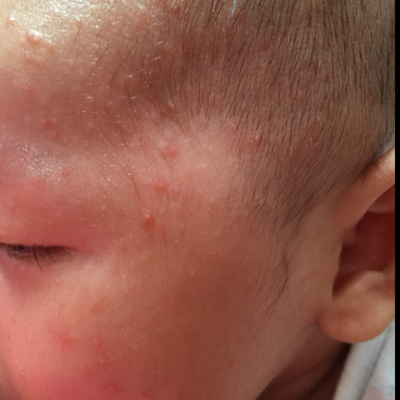 过敏和幼儿急疹的图片图片