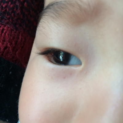 7岁宝宝眼睛下面发青图片