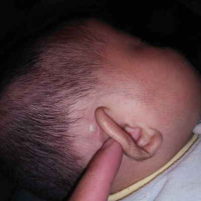 宝宝耳朵上长脓包图片图片