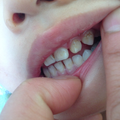 婴儿牙齿钙化怎么办图片