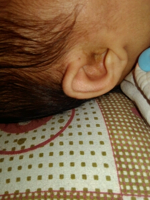 我女儿耳唇有褶皱,怎麼回事呀