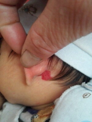 宝宝耳朵有红血点图片图片