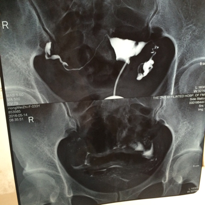 可部分宫腔粘连,能不能帮看看这个粘连是轻度还是严重