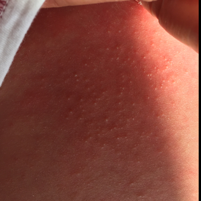 宝宝29天了,后背上起了一片片红,上边还有很多白色小颗粒,请问是湿疹