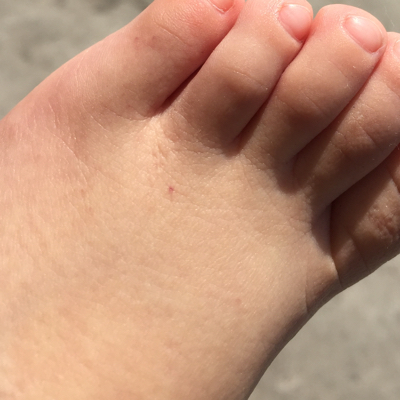 大家好,我家宝宝这几天脚上老是出现红点,消失了然后又起来,你们有