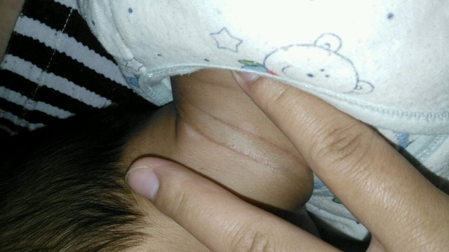 婴儿颈部起小白点图图片