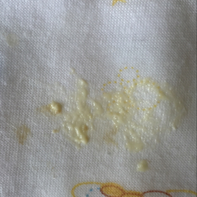 一个月零6天的宝宝今天吐奶渣裏面有褐色的东西,这是什麼情况?急死了