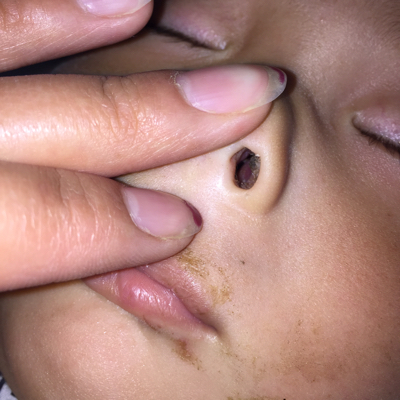 宝宝鼻子里长了东西 刚发现 请问这是什麼吖 是鼻子肉吗
