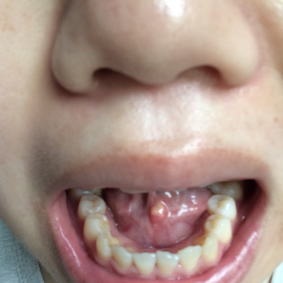 舌头底下血管瘤图片图片