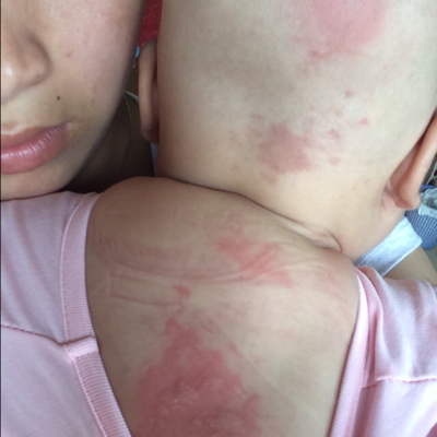 宝宝三个月洗澡不小心被不烫伤怎麼办