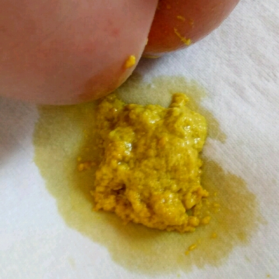 宝宝放屁有时候带屎有时候拉黄水!