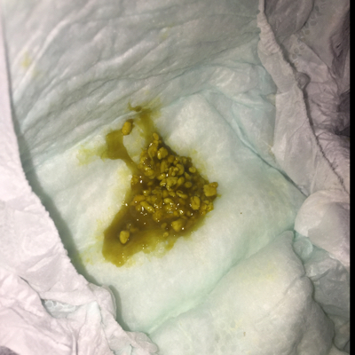 宝宝拉肚子,老是拉出奶瓣,怎麼办
