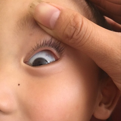 孩子白眼球有黑斑图片