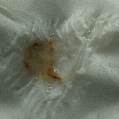 怀孕26周 5天,最近老师吐痰有血,已经半个多月了,半个月前流鼻血后,三