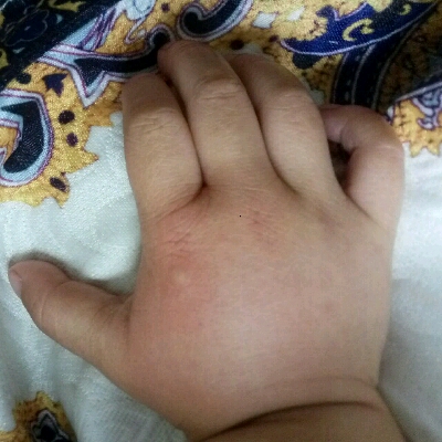 有谁知道我宝宝的手是怎麼了呀?昨天就肿了,搽了消毒止痛丁还是这样