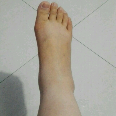 怀孕7个半月腿和脚都肿了,该怎麼办啊?