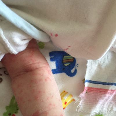宝宝奶粉过敏症状图片