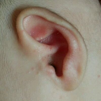 我女儿两个月半,耳朵出现膏药流脓一样,怎麼办