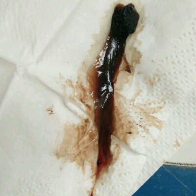 今天这是出的第一次黑色血块,后面也出了点血块,但是没有这麼多,后面