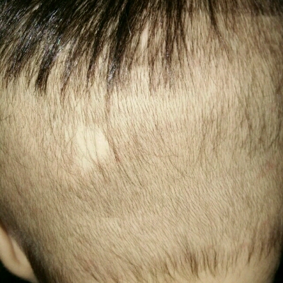 四个半月的后脑勺有一块没有头发也没有发根光秃秃的是什麼原因