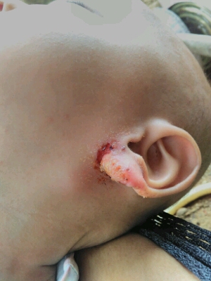 小孩耳朵根裂口图片图片