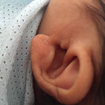 宝宝耳朵冻了症状图片图片