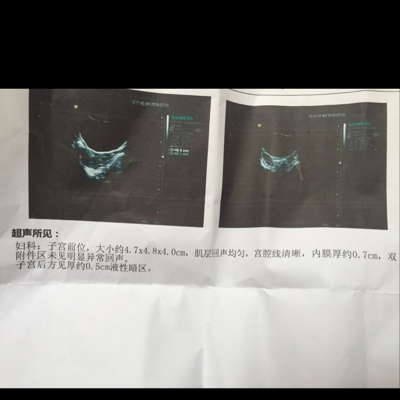 怀孕41天突然流血 伴有小腹痛 做b超未见孕囊 双子宫后方见厚约0 5cm液性暗区 刚刚上厕所有好大一块血块就出 怎么办 宝宝树