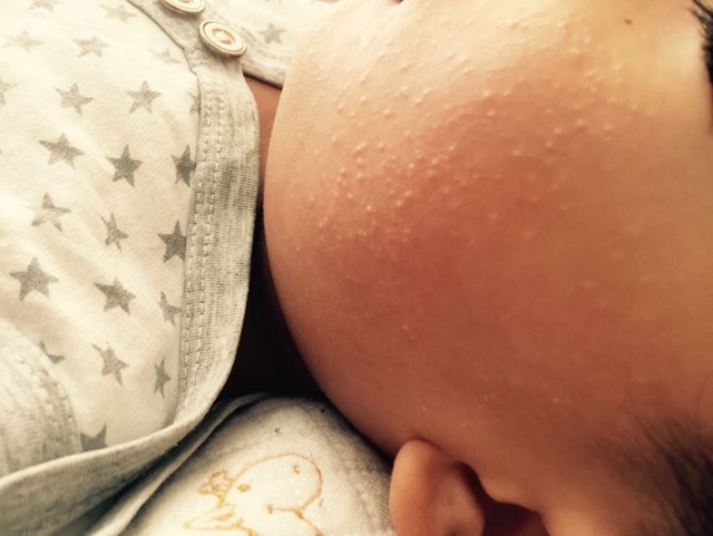 宝两岁了脸上长米粒大小的疙瘩不痛不痒一直不好_有知道的宝妈么_宝宝