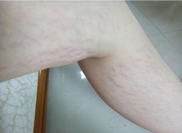 大家长妊娠纹了吗?